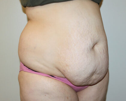 Tummy Tuck Before & After Patient #2583