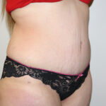 Tummy Tuck Before & After Patient #2583