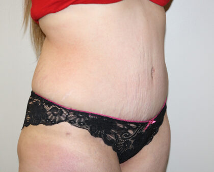 Tummy Tuck Before & After Patient #2583