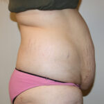 Tummy Tuck Before & After Patient #2583