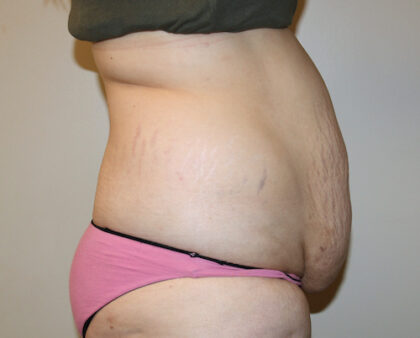 Tummy Tuck Before & After Patient #2583