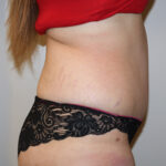 Tummy Tuck Before & After Patient #2583