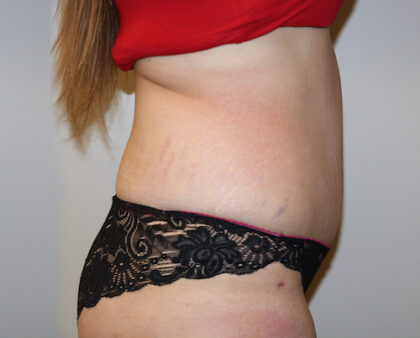 Tummy Tuck Before & After Patient #2583