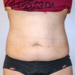 Tummy Tuck Before & After Patient #2590