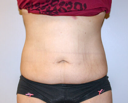 Tummy Tuck Before & After Patient #2590