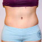 Tummy Tuck Before & After Patient #2590