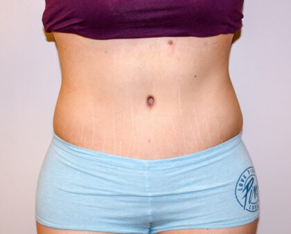 Tummy Tuck Before & After Patient #2590