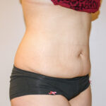 Tummy Tuck Before & After Patient #2590