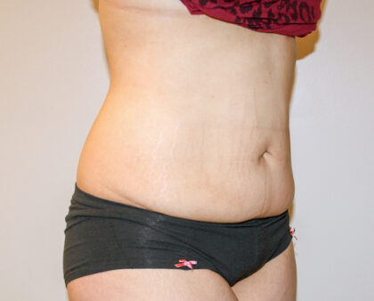 Tummy Tuck Before & After Patient #2590