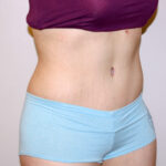 Tummy Tuck Before & After Patient #2590