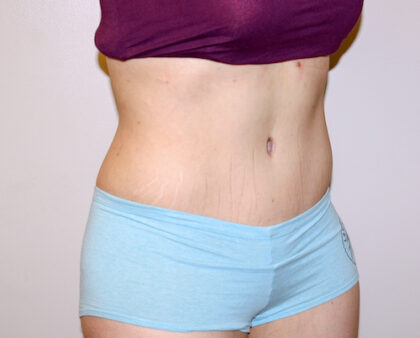 Tummy Tuck Before & After Patient #2590