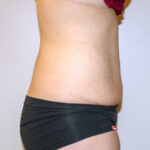 Tummy Tuck Before & After Patient #2590