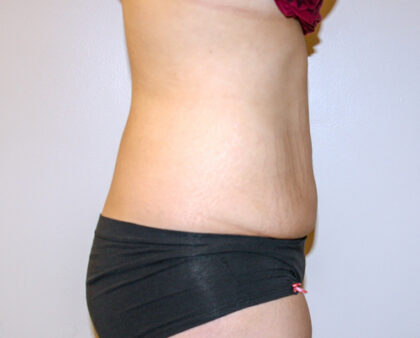 Tummy Tuck Before & After Patient #2590