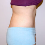 Tummy Tuck Before & After Patient #2590