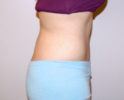 Tummy Tuck Before & After Patient #2590