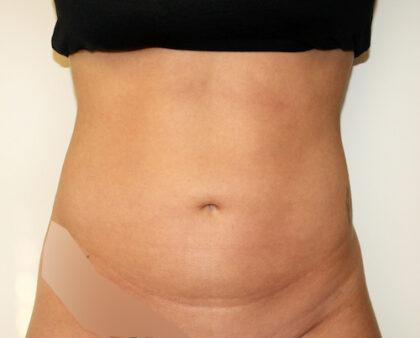 Liposuction Before & After Patient #2468