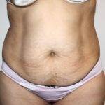 Tummy Tuck Before & After Patient #2597