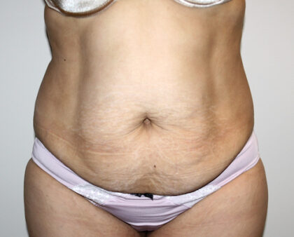 Tummy Tuck Before & After Patient #2597