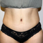 Tummy Tuck Before & After Patient #2597