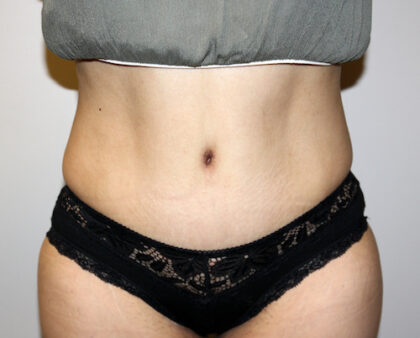 Tummy Tuck Before & After Patient #2597