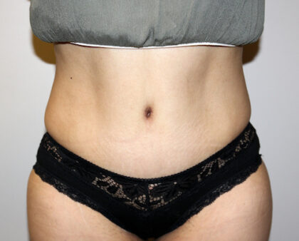 Bra Roll Liposuction in Santa Monica