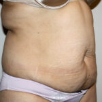 Tummy Tuck Before & After Patient #2597