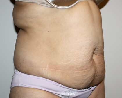 Tummy Tuck Before & After Patient #2597