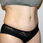 Tummy Tuck Before & After Patient #2597