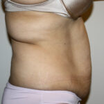 Tummy Tuck Before & After Patient #2597