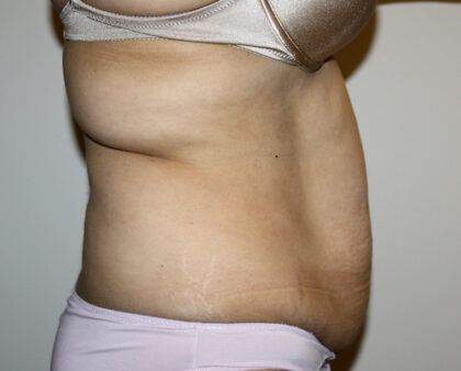 Tummy Tuck Before & After Patient #2597