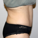 Tummy Tuck Before & After Patient #2597