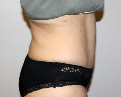 Tummy Tuck Before & After Patient #2597