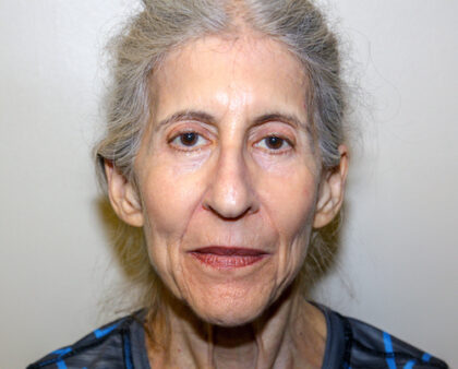 Facelift Before & After Patient #2447