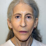 Facelift Before & After Patient #2447