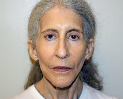 Facelift Before & After Patient #2447