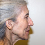 Facelift Before & After Patient #2447