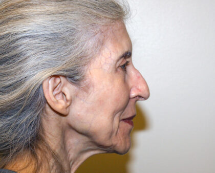 Facelift Before & After Patient #2447