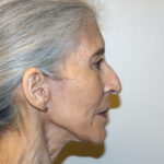 Facelift Before & After Patient #2447