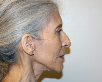 Facelift Before & After Patient #2447