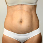 Tummy Tuck Before & After Patient #2604