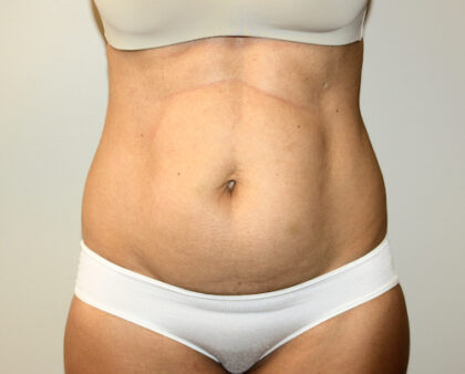 Tummy Tuck Before & After Patient #2604