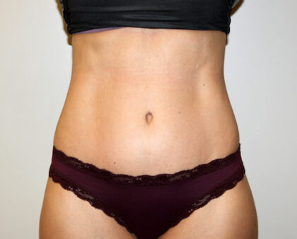 Tummy Tuck Before & After Patient #2604