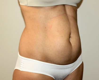 Tummy Tuck Before & After Patient #2604
