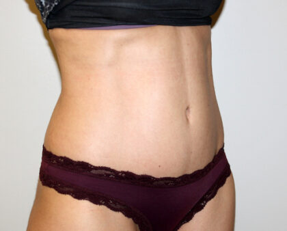 Tummy Tuck Before & After Patient #2604