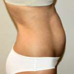 Tummy Tuck Before & After Patient #2604