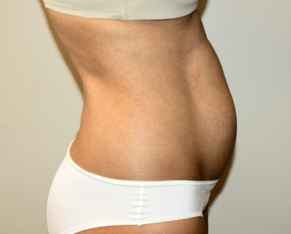 Tummy Tuck Before & After Patient #2604