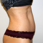 Tummy Tuck Before & After Patient #2604