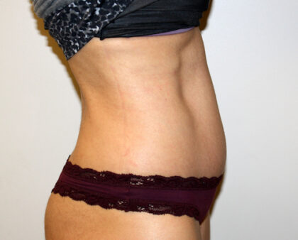 Tummy Tuck Before & After Patient #2604