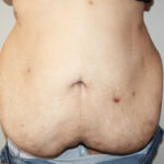 Major Weight Loss Tummy Tuck Before & After Patient #2485