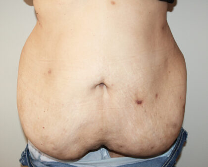 Major Weight Loss Tummy Tuck Before & After Patient #2485